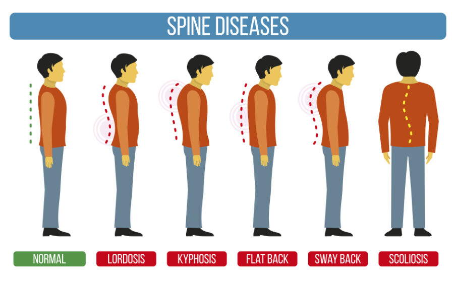 What is scoliosis and how is it characterized?