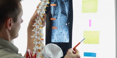 doctor comparing a model spine with an x-ray of a spine with sticky notes and flags on the x-ray board